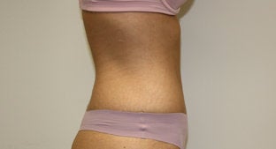 Abdominoplasty 486527