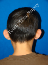 Ear Surgery (Otoplasty) before 579094