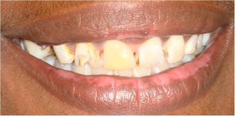 6 dental crowns to repair badly broken down teeth before 328052