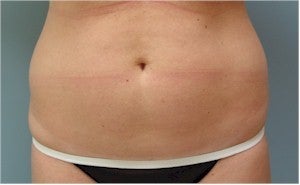 SmartLiposuction before 601954