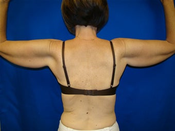 Arm Lift Surgery before 138182