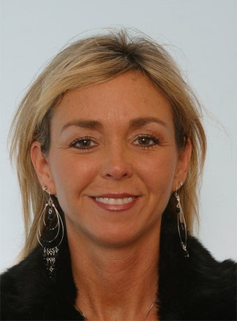 Botox before 260041