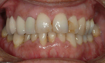 Full Porcelain Crowns before 145686