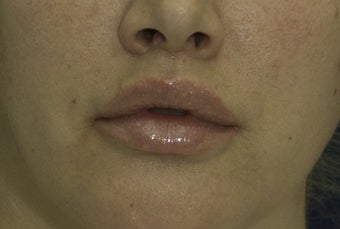 Lip Lift after 606639