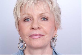 Juvederm Injection after 337260