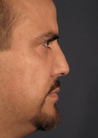 Revision Rhinoplasty 410622