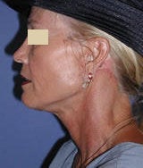 Neck Lift Surgery after 124955
