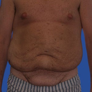 Abdominoplasty before 254382
