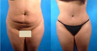 Tummy Tuck and Liposuction before 101828