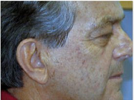 CO2 Fractional Laser before 459873