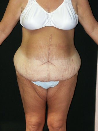 Body Lift before 379789