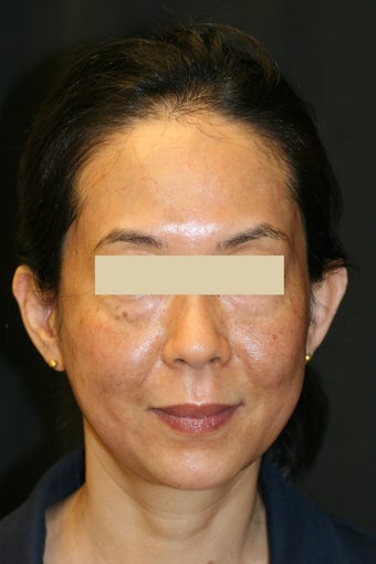 Fraxel Laser after 130147