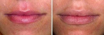 Lip Volumizing before 185802