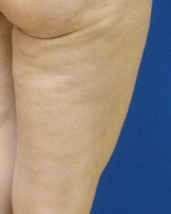 Cellulaze after 582615