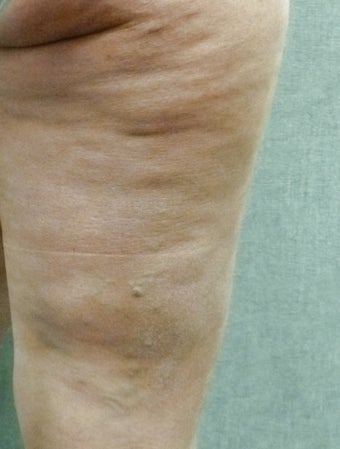 Cellulaze before 571586
