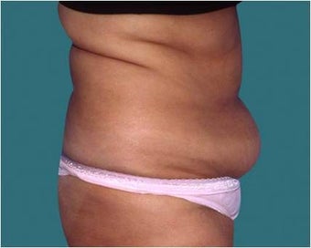 Liposuction 590650