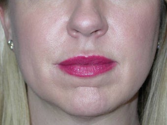 Fillers after 148701