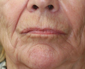 Lip lift, corner of lip lift, and filler around lips before 299921
