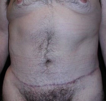 Male tummy Tuck after 578190