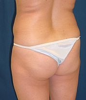 Brazilian Butt Lift before 98187