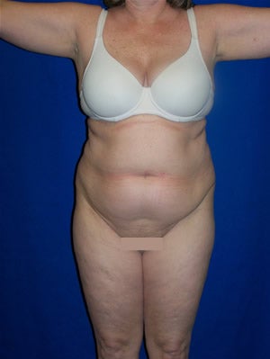 Tummy Tuck Surgery (Abdominoplasty) before 161996