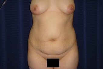 Tummy tuck with liposuction of the flanks before 247948