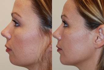 Chin Implant, profile view before 95082