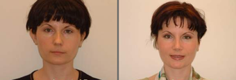 Otoplasty and Rhinoplasty before 95866
