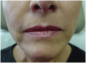 juvederm after 267545