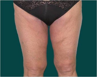 Thigh lift after 589899