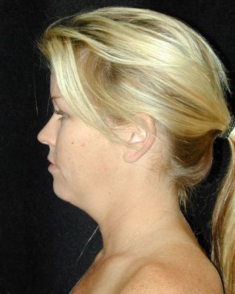 Liposuction of the Chin before 214684