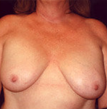 Breast implant removal and breast lift. before 316568
