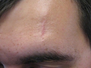 Severe, Deep Scars with Pixel after 272103