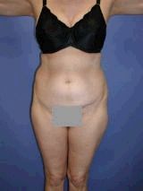 Tummy Tuck Surgery (abdominoplasty) before 143886