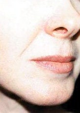 Facial Fillers before 341053