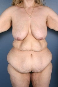Body Lift, Medial Thigh Lift, Arm Lift, Breast Reduction before 456149