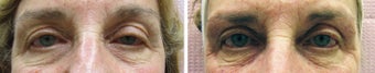 Eye Rejuvenation Restylane before 315010