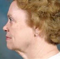Facelift and Blepharoplasty before 209326