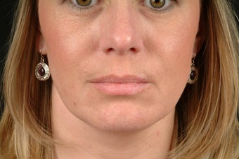 Botox 531606