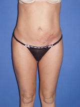 Tummy Tuck Surgery before 124891