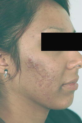 Laser Acne Treatment before 82974