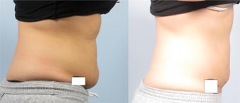 Coolsculpting - Zeltiq before 256148