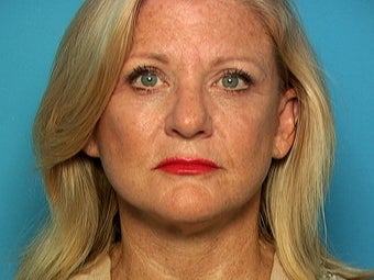 Facelift and Blepharoplasty after 141133