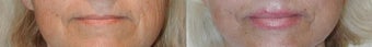 Lip Lift before 641423