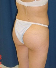 Brazilian Butt Lift after 635107