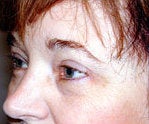 browlift and upper eyelid surgery after 84478