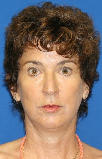 Facelift, Lateral Browlift, Fat Transfer, Chemical Peel after 399966