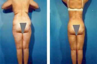Liposuction before 636165