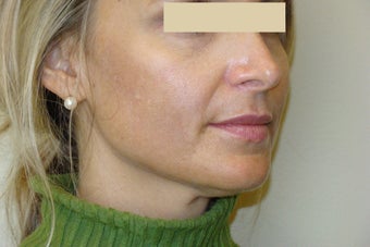 Active FX Laser Resurfacing before 132711