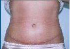 Abdominoplasty after 67003